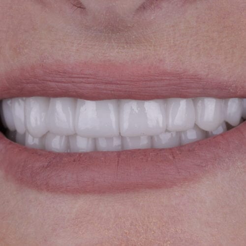 Cosmetic Dentistry Before & After Photos Broomall PA