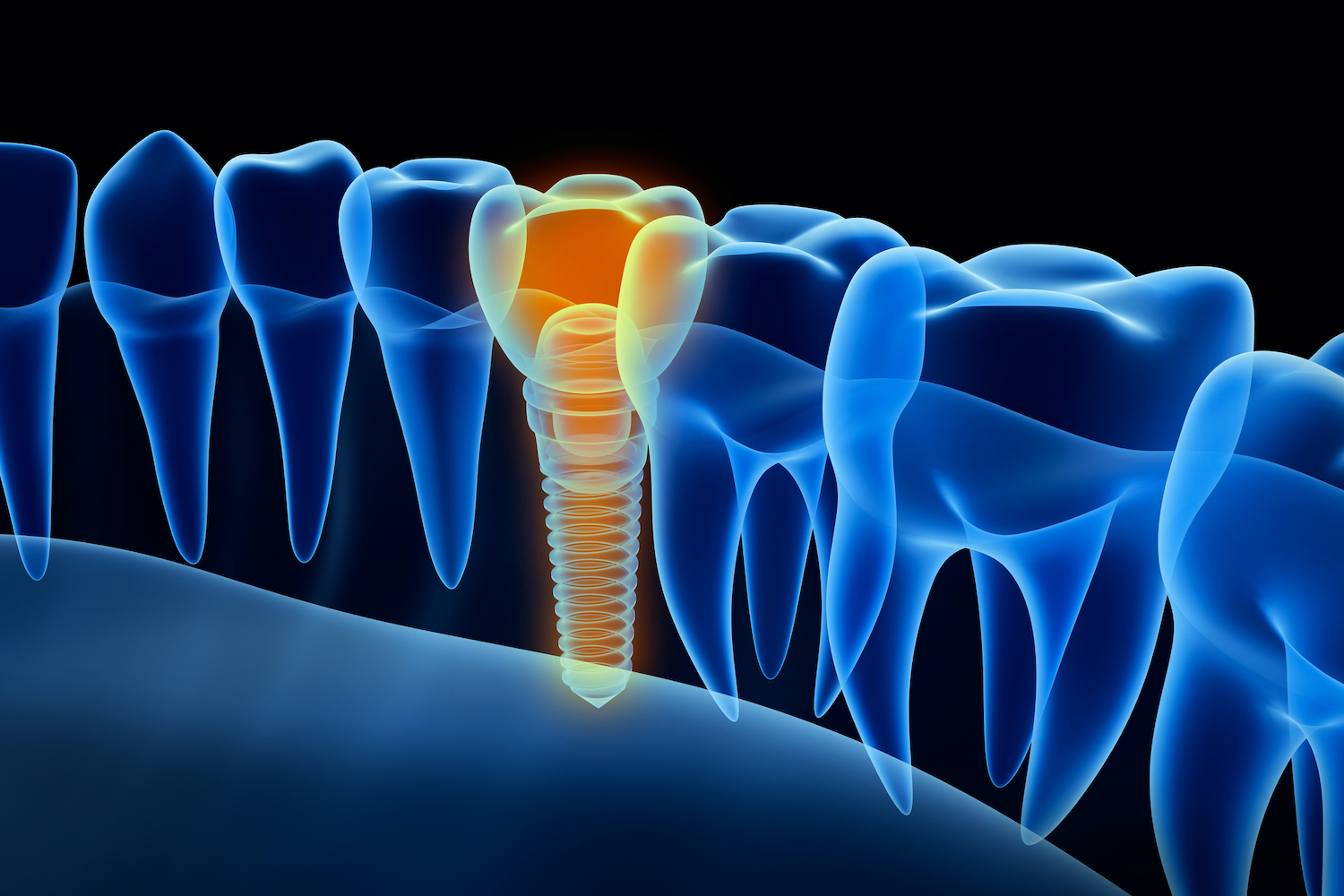 DENTAL IMPLANTS in BROOMALL PA may not be available for every patient