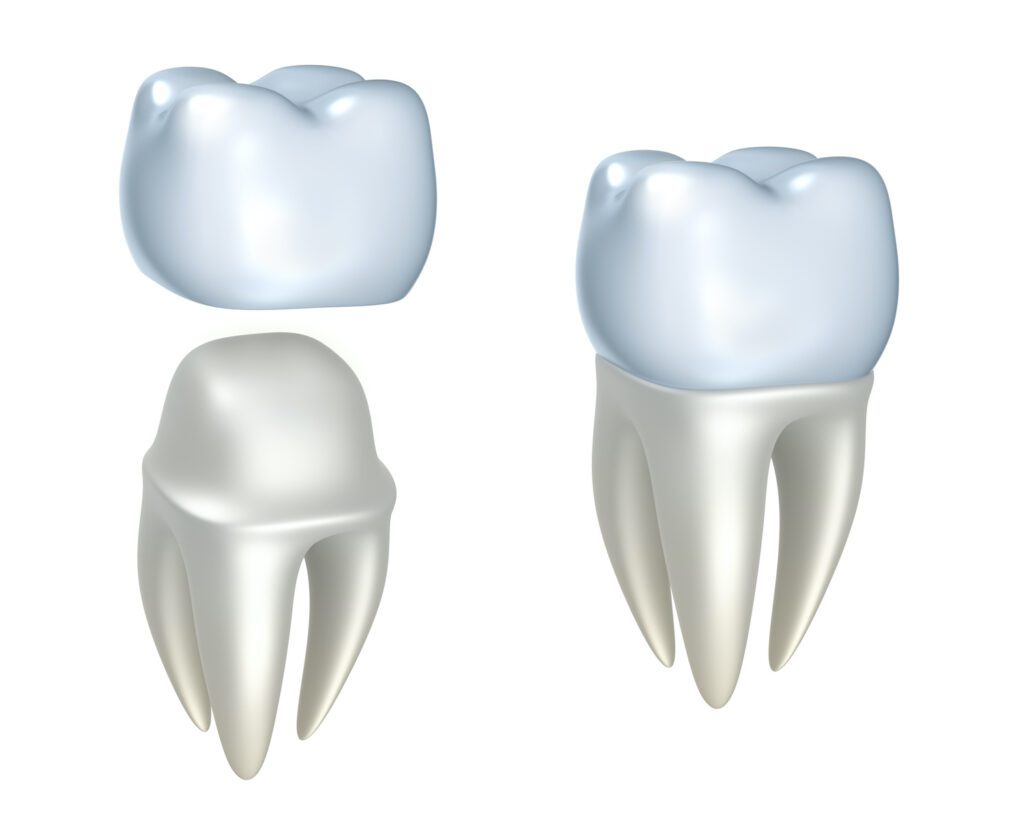 A DENTAL CROWN in BROOMALL PA needs care and attention to ensure it lasts a long time