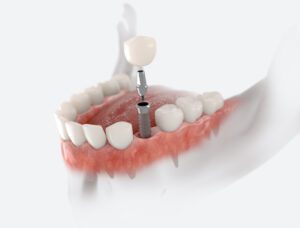 Implant dentistry offers many benefits over traditional treatment options